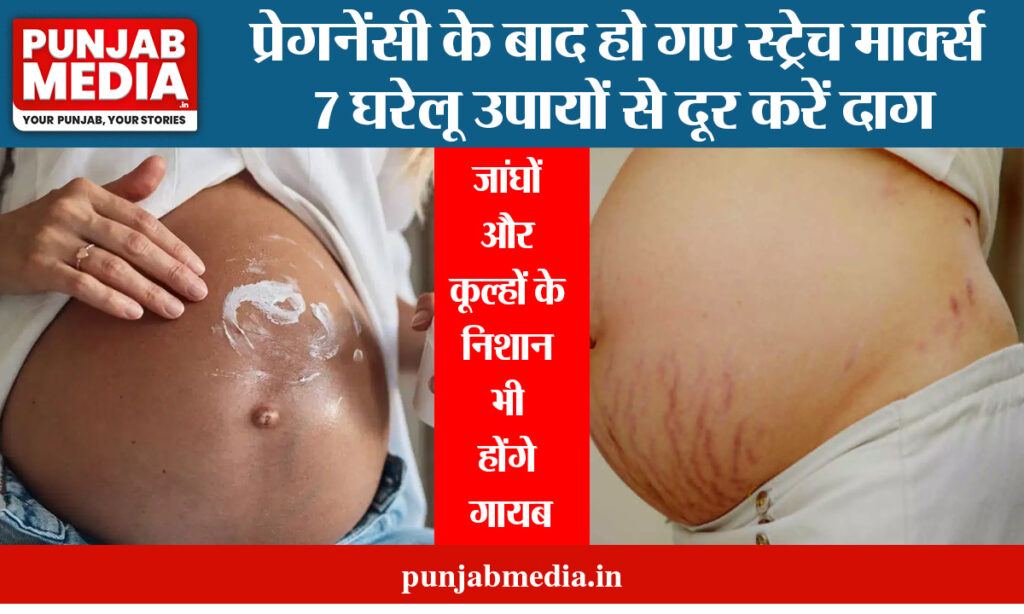 Stretch Marks